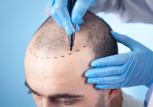 Navigating Hair Restoration: How A Health Consultant Can Guide You Through FUT Transplantation In The Bay Area